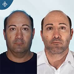 Before After