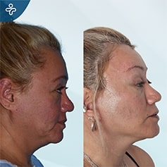 temporal lift patient before and after