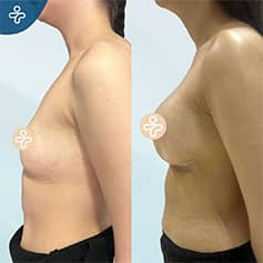 Before After