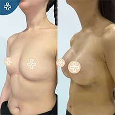 Before After