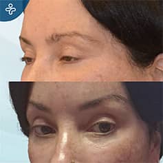Before After