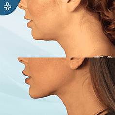 double-chin-surgery-(1)