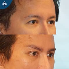 Antes Después