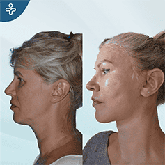 revision-facelift-surgery-(1)