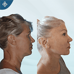 revision-facelift-surgery-2-(1)