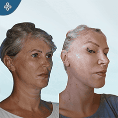 revision-facelift-surgery-3-(1)