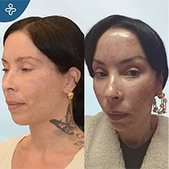 temporal lift patient before and after