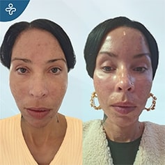 temporal lift patient before and after