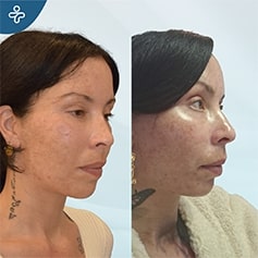 temporal lift patient before and after