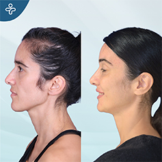 temporal lift patient before and after