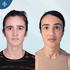 temporal lift patient before and after