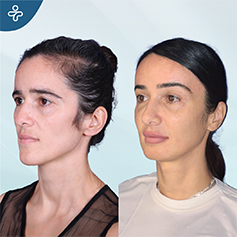 temporal lift patient before and after