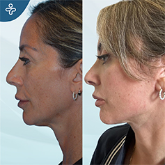 temporal lift patient before and after