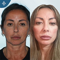temporal lift patient before and after