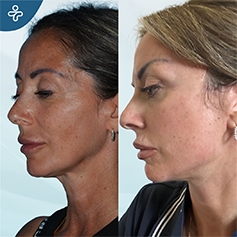 temporal lift patient before and after