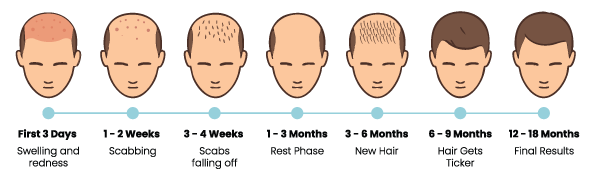 Illustrated timeline showing hair transplant recovery stages and hair growth progression