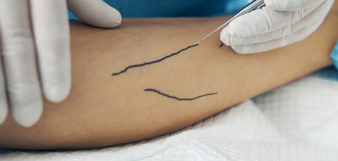 Surgeon marking leg for peripheral nerve injury surgery before treatment procedure