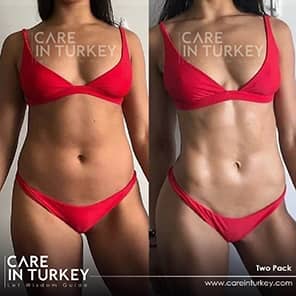 Sixpack-Operation Patient Vorher Nachher