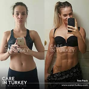 Sixpack-Operation Patient Vorher Nachher