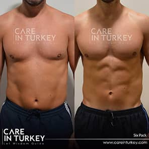 Sixpack-Operation Patient Vorher Nachher