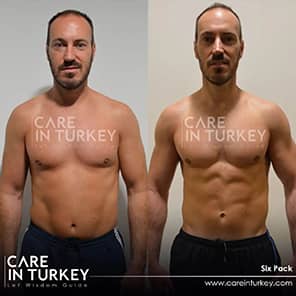 Sixpack-Operation Patient Vorher Nachher