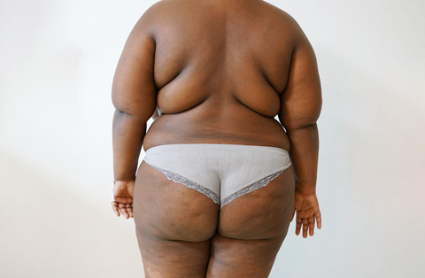 Back view of woman in Turkey before bariatric surgery, showing excess body fat and skin before weight loss procedure.