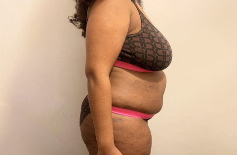 Side view of woman with excess abdominal fat and loose skin before bariatric surgery in Turkey, wearing sports bra and underwear.