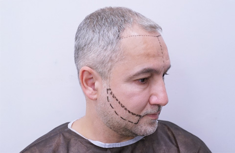 Male patient with pre-op markings on face for beard transplant procedure