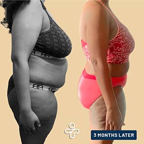 Paziente prima e dopo il bypass gastrico