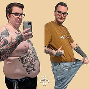 Paziente prima e dopo il bypass gastrico