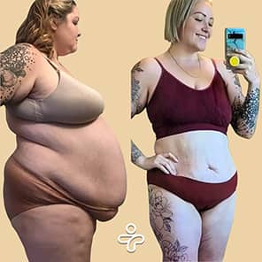 Paziente prima e dopo il bypass gastrico