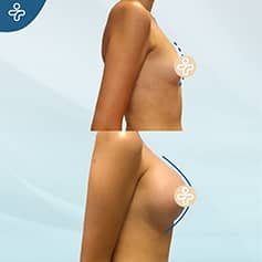 Before After