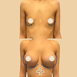 Patient lifting des seins avant après