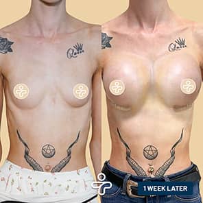 Patient lifting des seins avant après