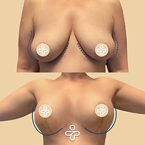 Patient lifting des seins avant après