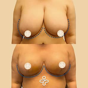 Patient lifting des seins avant après