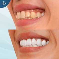 Before After Dentistry