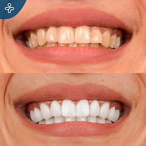 Before After Dentistry