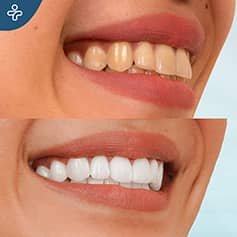 Before After Dentistry