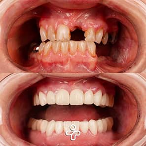 Paziente con impianto dentale prima e dopo