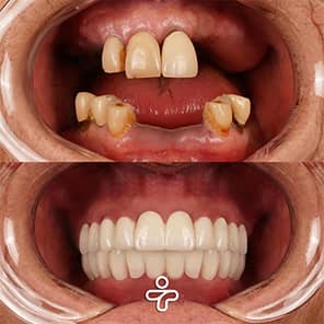 Paziente con impianto dentale prima e dopo