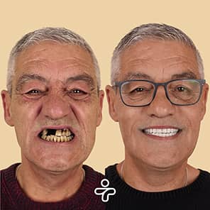 Paziente con impianto dentale prima e dopo