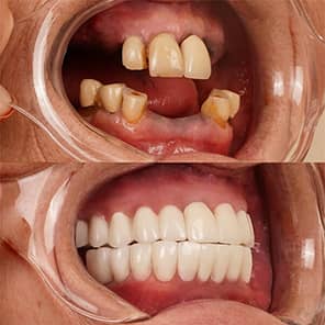 Paziente con impianto dentale prima e dopo