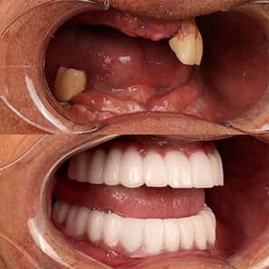 Paziente con impianto dentale prima e dopo