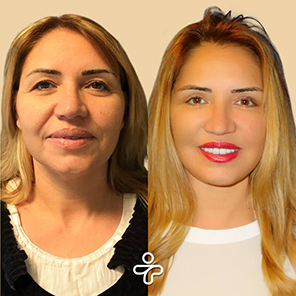 Paciente de Estiramiento Facial Antes y Después