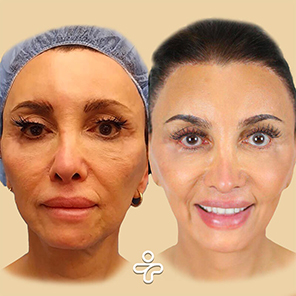 Paciente de Estiramiento Facial Antes y Después