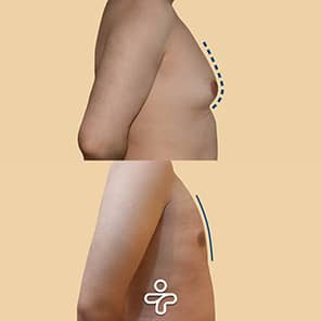 Paziente ginecomastia prima e dopo