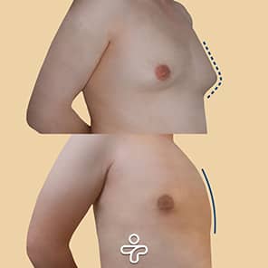 Paziente ginecomastia prima e dopo