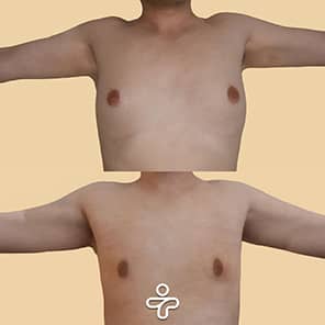 Paziente ginecomastia prima e dopo