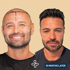 Haartransplantation Patient vorher nachher